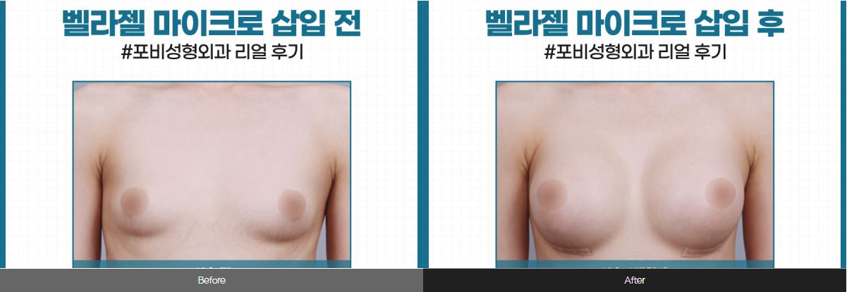  전후사진