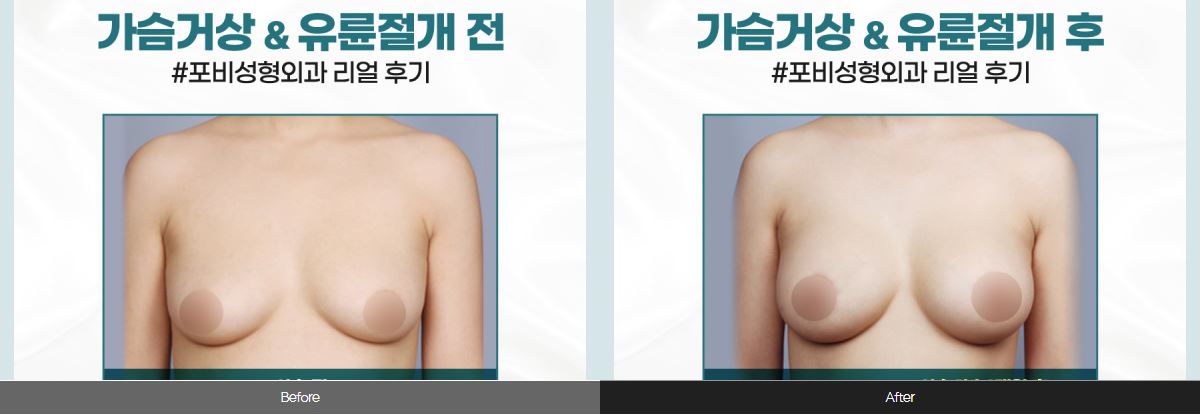  전후사진
