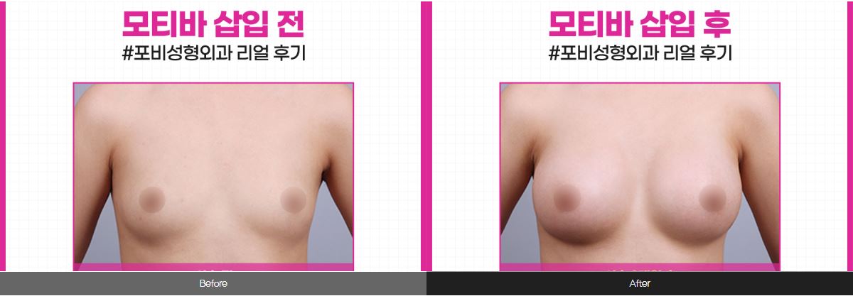  전후사진