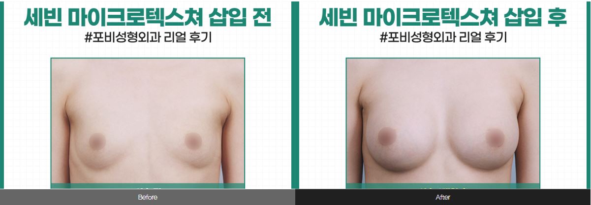  전후사진
